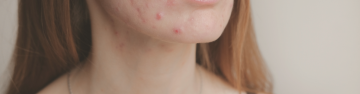 Unlock The Secret The Clear Skin - Breaking Down Acne Causes