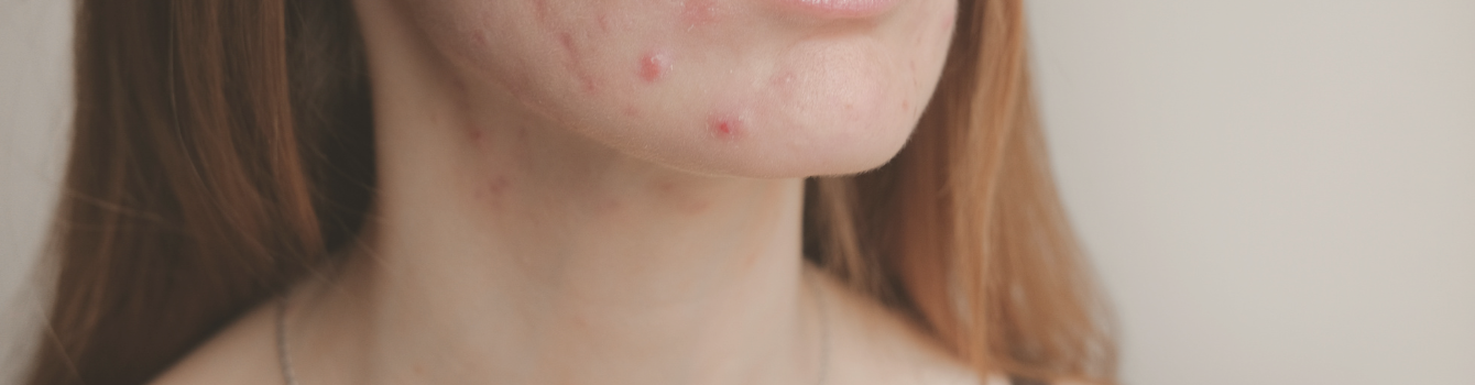 Banish Stubborn Acne! Get Your Best Skin Back